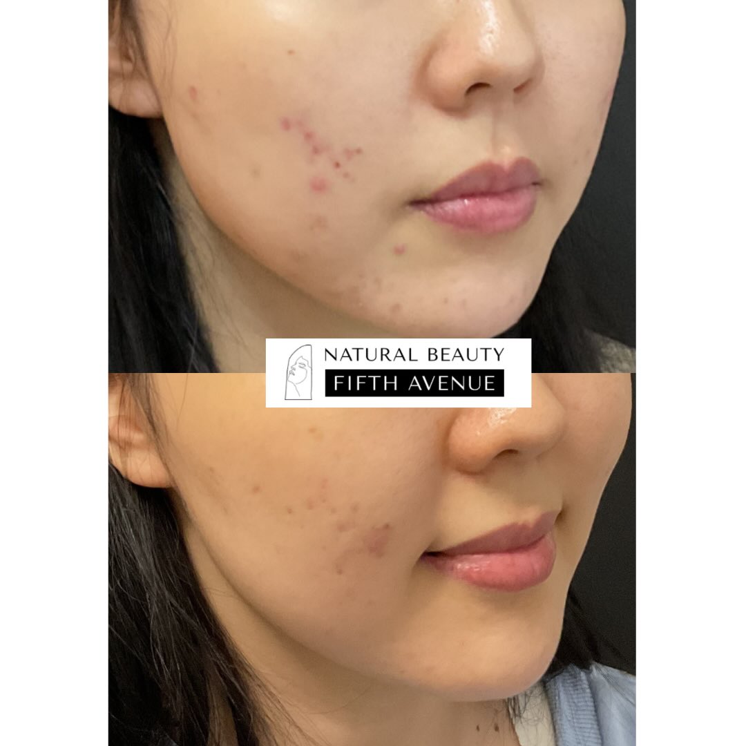 Before and after chemical peel results showing reduced acne and improved skin texture